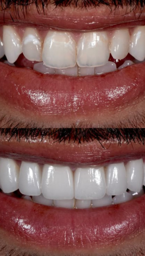 Resultado real de paciente — antes e depois