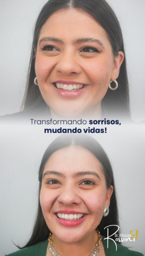 Resultado real de paciente — antes e depois
