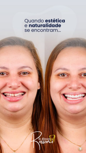 Resultado real de paciente — antes e depois
