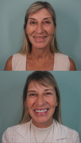 Resultado real de paciente — antes e depois